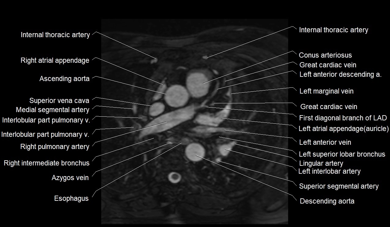 MRI heart coronary arteries and coronary veins anatomy axial image 10.webp